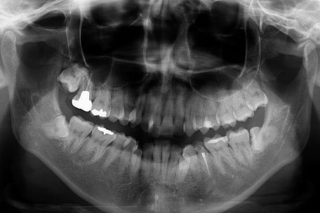 歯科用デジタル３次元CTイメージ01